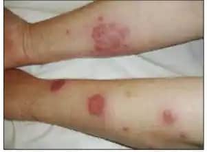 Kolda Çıkan Kızarıklıkların Nedenleri, Önlenmesi ve Etkili Tedavi Yöntemleri