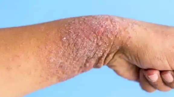 Kolda Egzama Belirtileri, Nedenleri ve Etkili Tedavi Yöntemleri Hakkında Detaylı Bilgi