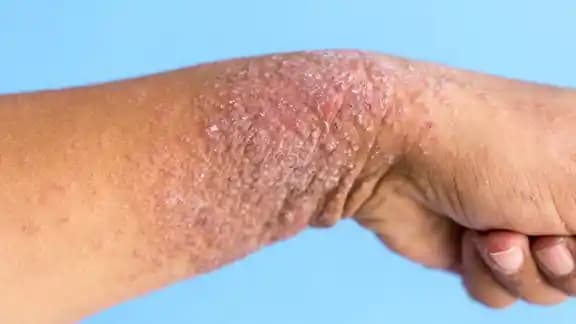 Kolda Egzama Belirtileri, Nedenleri ve Etkili Tedavi Yöntemleri Hakkında Detaylı Bilgi