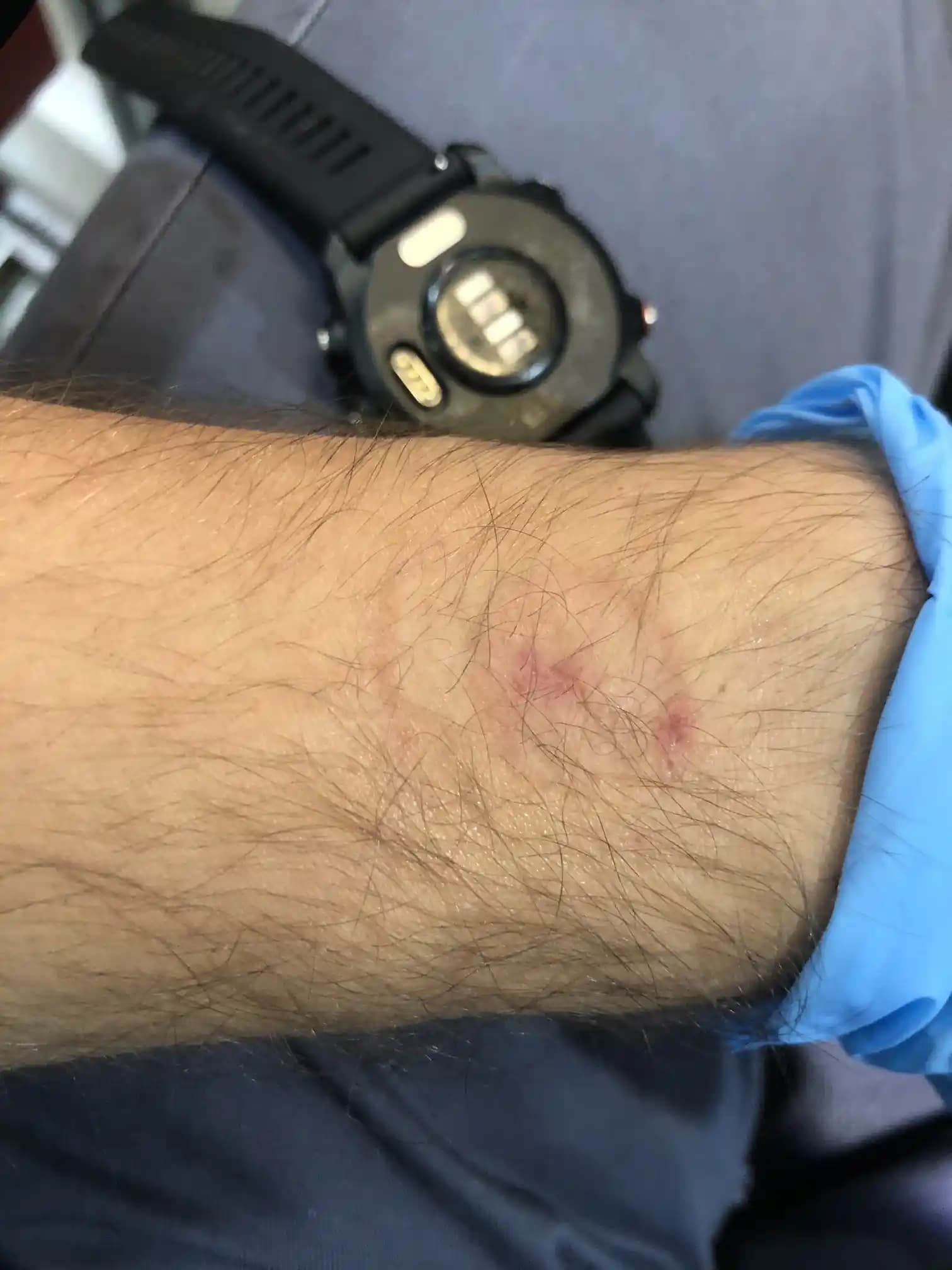 Kolda Kızarıklık ve Yanma Sorunları için Doğal Çözüm Yolları ve Cilt Bakım İpuçları