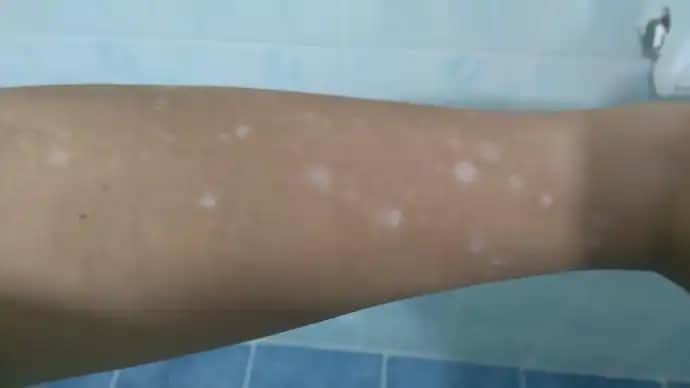 Kolda Leke Nedenleri ve Çözüm Yolları: Kozmetik Yaklaşımlarla Etkili Tedavi Rehberi