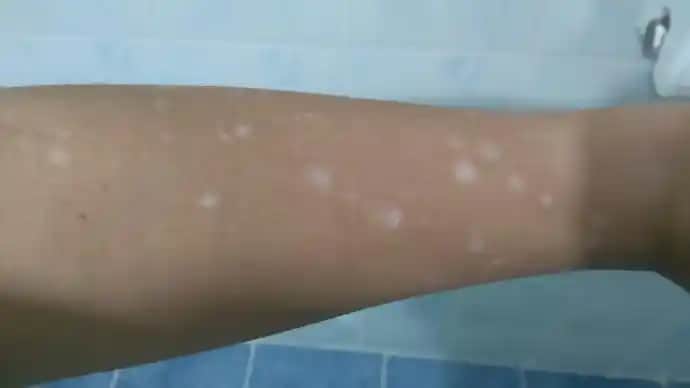 Kolda Leke Sorunu ve Çözüm Yolları: Güzellik ve Sağlık İçin Bilmeniz Gerekenler