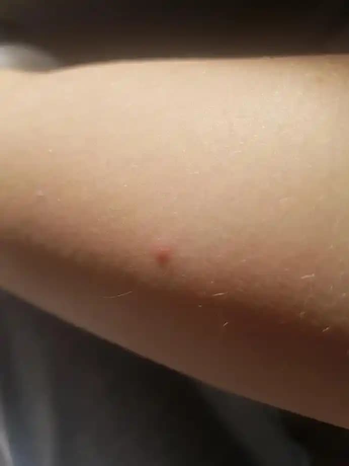 Kolda Sivilce Nedenleri ve Etkili Çözüm Yolları Hakkında Kapsamlı Bilgi