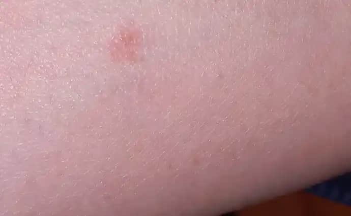 Kolda Yeşil Leke Nedenleri, Belirtileri ve Etkili Tedavi Yöntemleri