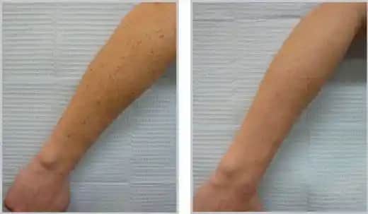 Koldaki Güneş Lekeleri Nasıl Geçer: Doğal ve Medikal Tedavi Yöntemleri