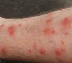 Koldaki Lekelerin Nedenleri ve Etkili Tedavi Yöntemleri Hakkında Detaylı Bilgi