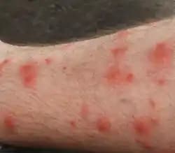 Koldaki Lekelerin Nedenleri ve Etkili Tedavi Yöntemleri Hakkında Detaylı Bilgi