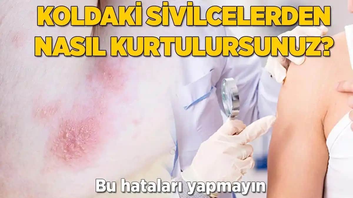 Koldaki Sivilceler: Nedenleri, Çözüm Yolları ve Bakım İpuçları