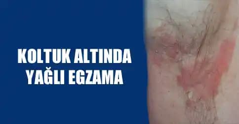 Koltuk Altı Egzaması Nedir, Belirtileri ve Etkili Bakım Yöntemleri