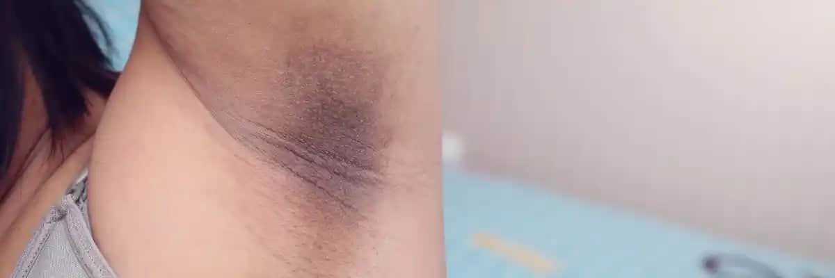 Koltuk Altı Kararması Nedenleri Çözümleri ve Önleyici Yöntemler Hakkında Bilgi