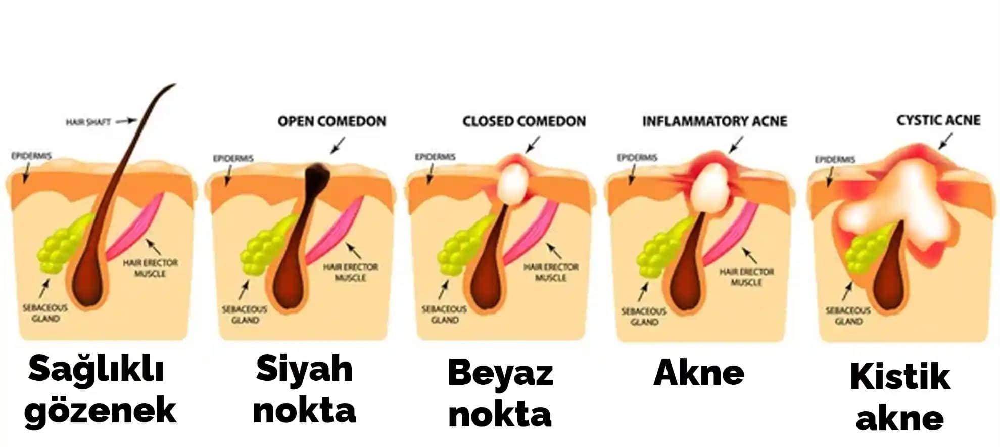 Komedon ve Sivilce Tedavisi İçin Bilmeniz Gerekenler Cilt Sağlığınızı Koruma Yöntemleri