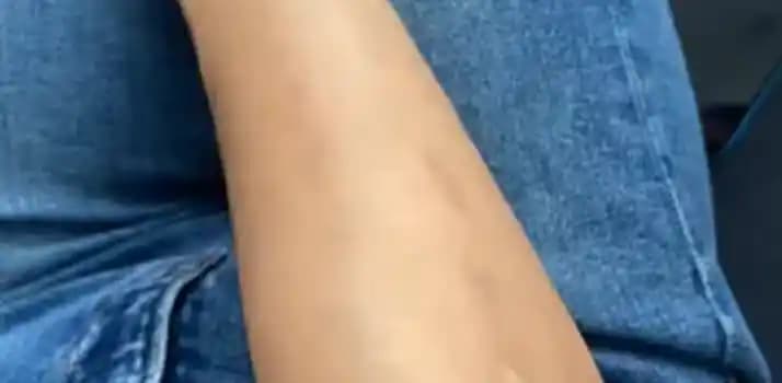 Kozmetik Dünyasında Güvenli ve Sağlıklı Bakım Yöntemleriyle Kol Yanığını Önleme