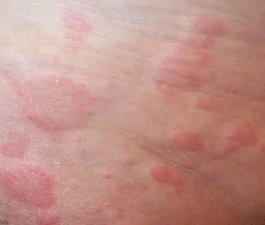 Kozmetik Ürünlerin Ciltteki Kızarıklık ve Kaşıntıya Etkisi Bilinçli Kullanımın Önemi