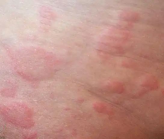 Kozmetik Ürünlerin Ciltteki Kızarıklık ve Kaşıntıya Etkisi Bilinçli Kullanımın Önemi