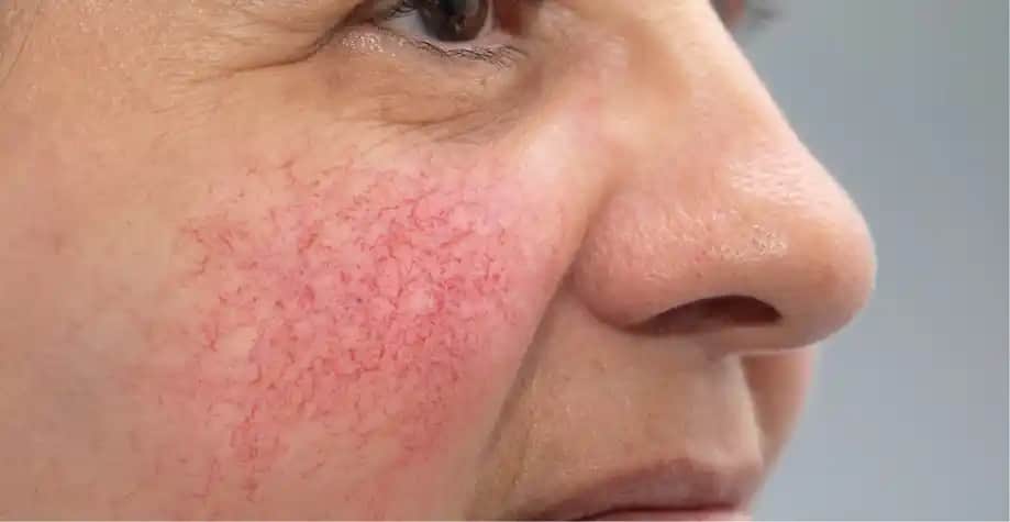 Kuperoz Nedir ve Kozmetik Bakımda Etkili Çözüm Yolları Hakkında Bilmeniz Gerekenler