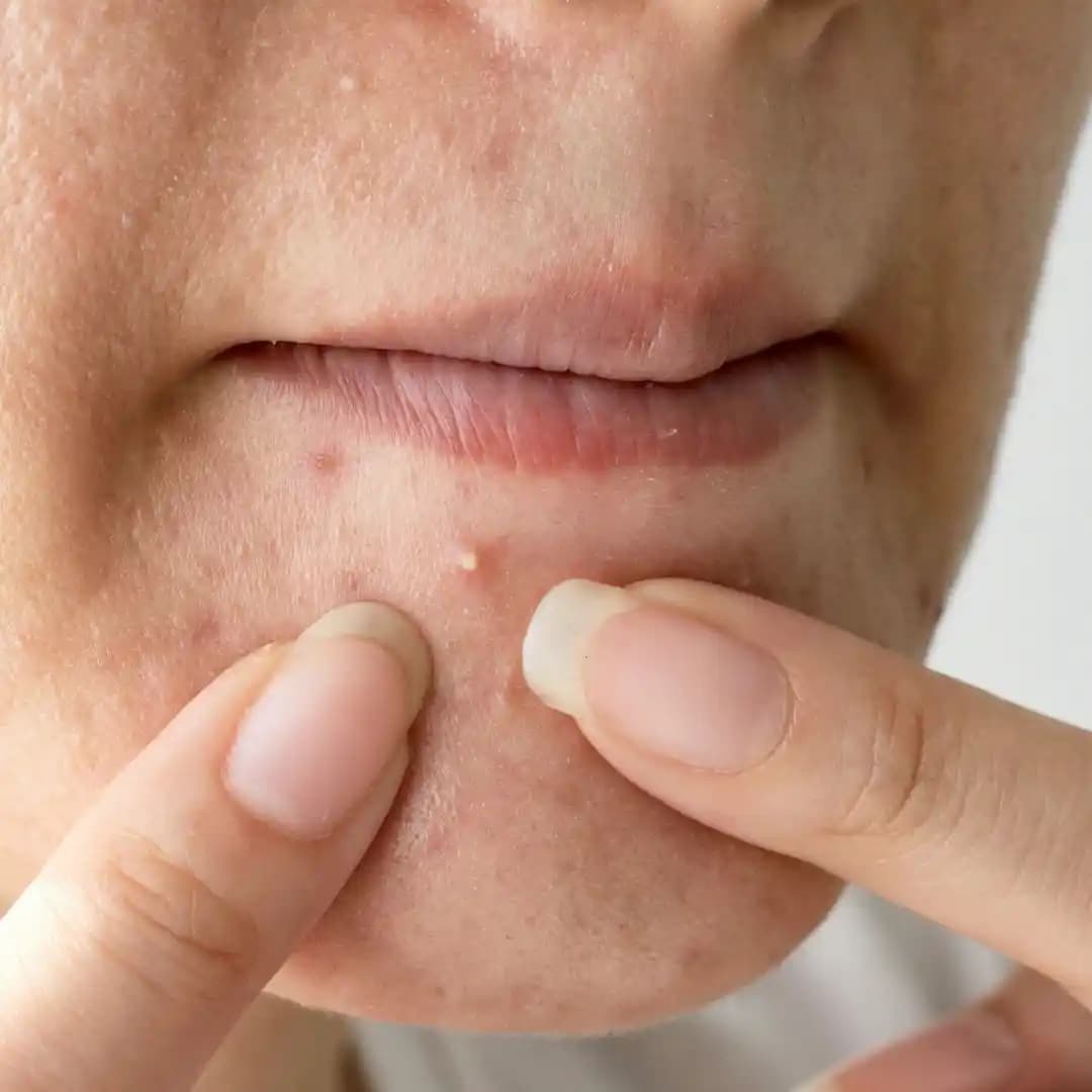 Kuru Ciltte Sivilce Nedenleri ve Etkili Bakım Yöntemleri Hakkında Bilgi