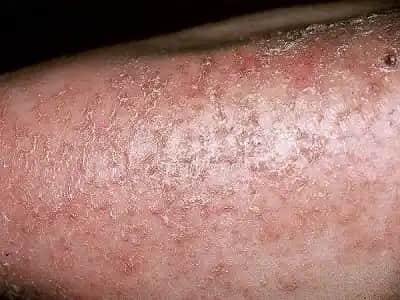 Kuru Deri Nedir, Nedenleri ve Doğru Bakım Yöntemleri ile Cilt Sağlığını Koruma