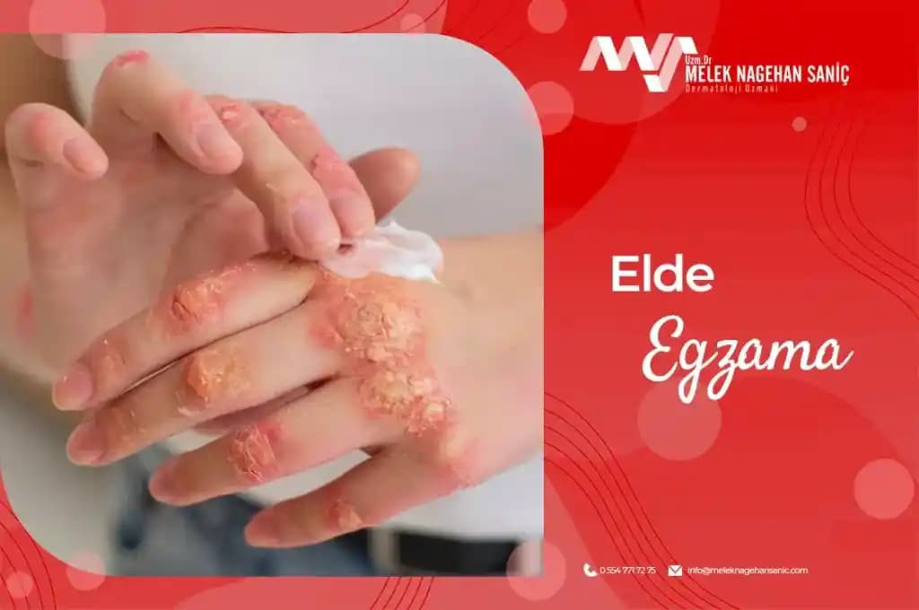 Kuru Egzama Nedir, Belirtileri ve Etkili Tedavi Yöntemleri Hakkında Bilgiler