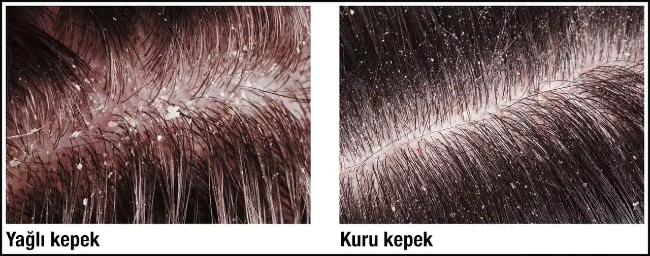 Kuru Kepek Nedenleri ve Etkili Çözüm Yolları Hakkında Detaylı Bilgi