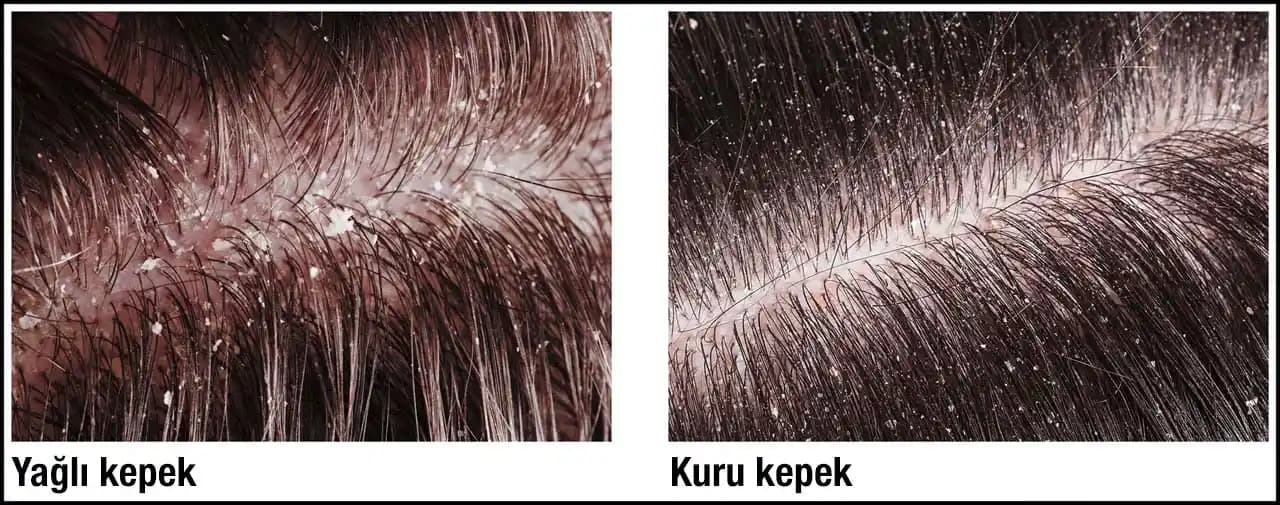 Kuru Kepek Nedenleri ve Etkili Çözüm Yolları Hakkında Detaylı Bilgi