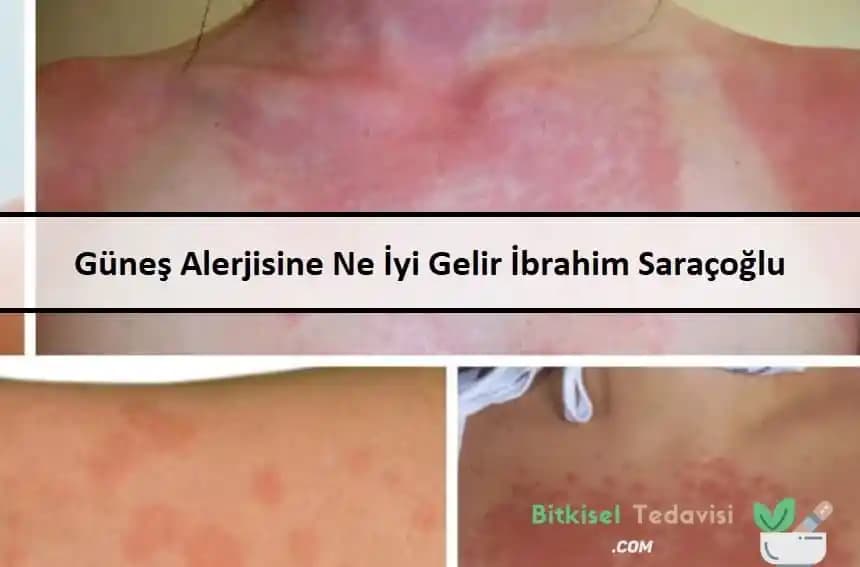 Lazer Alerjisine Karşı Etkili Önlemler ve Doğal Yöntemler