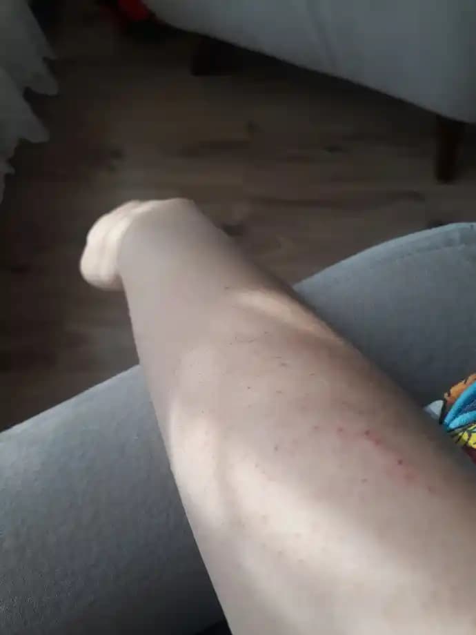 Lazer Sonrası Alerji ve Cilt Reaksiyonları: Güvenli Uygulama ve Bakım İpuçları