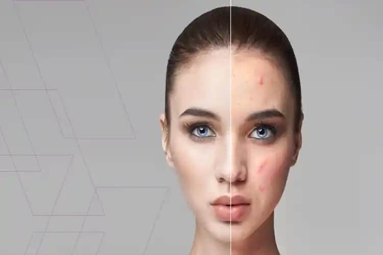 Lazer Yüzey İşlemleri ve Sivilce Endişeleri: Güvenli ve Etkili Kullanım Rehberi