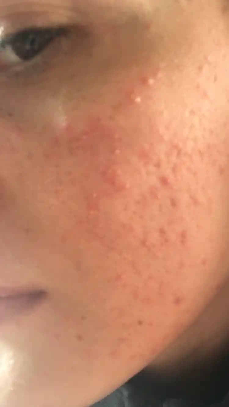 Mantar Sivilcesi Nedir, Nedenleri ve Etkili Tedavi Yöntemleri Hakkında Bilgi