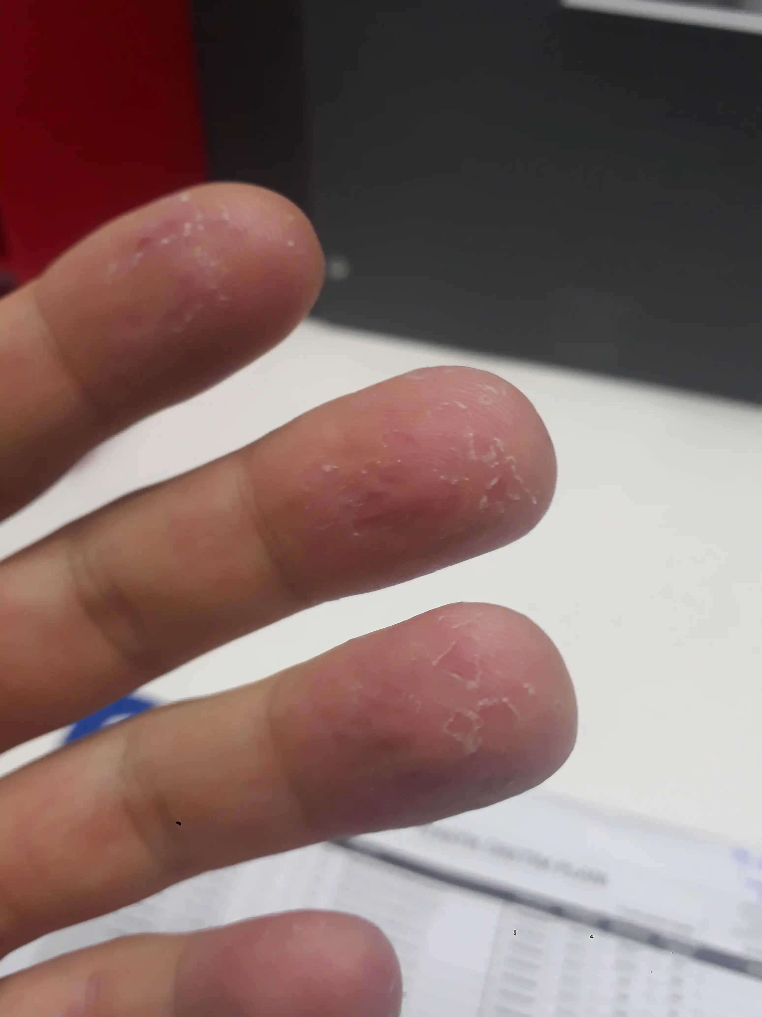 Mevsimsel Egzama Nedir, Belirtileri ve Etkili Bakım Yöntemleri Hakkında Detaylı Bilgi