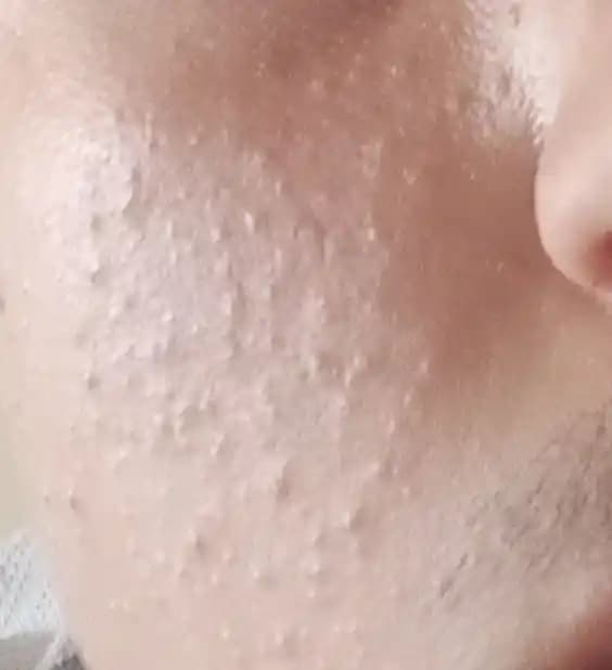 Minik Sivilcelerle Mücadele: Doğru Bakım ve Etkili Çözüm Yöntemleri