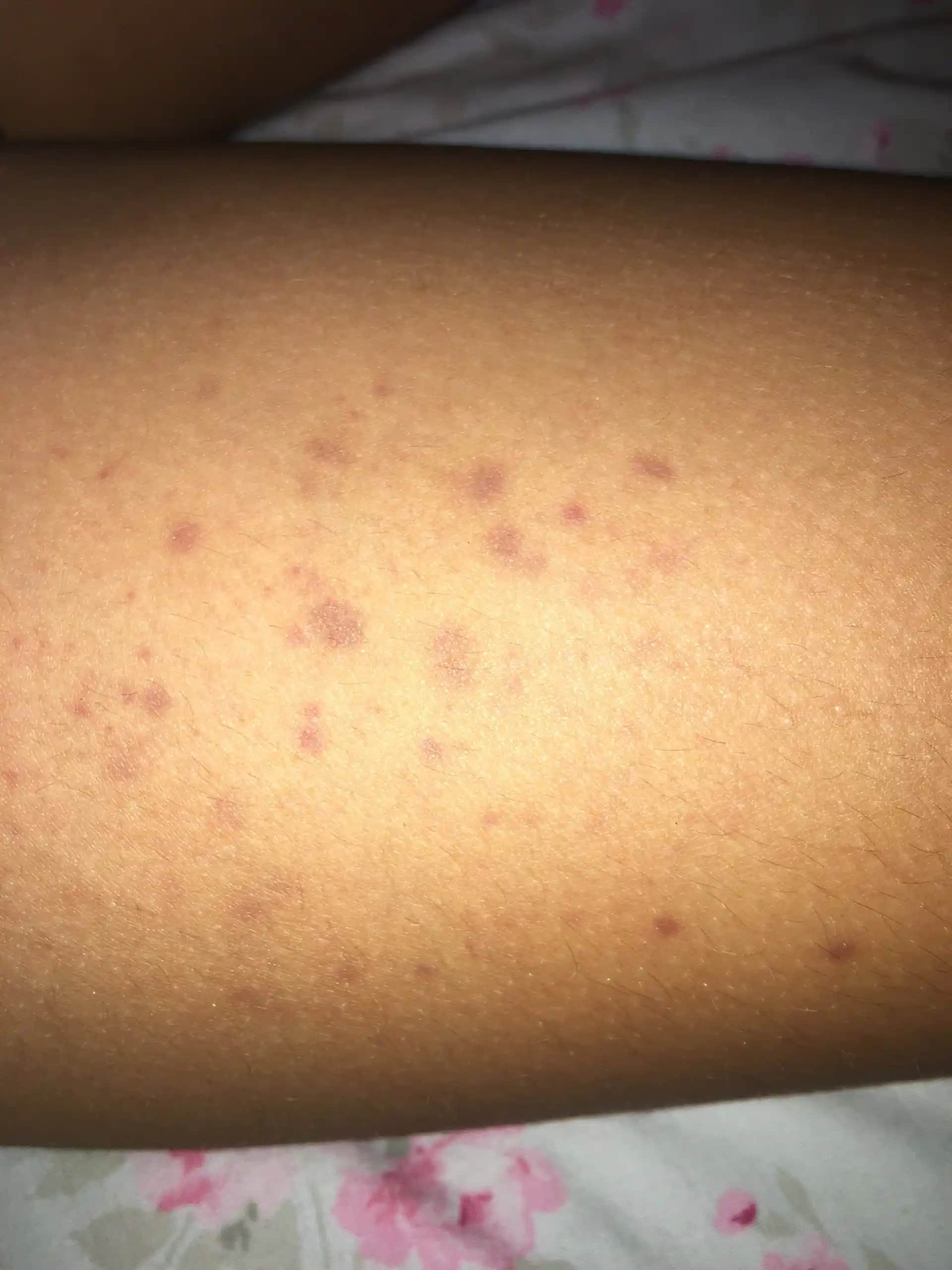 Nokta Nokta Morluklar: Nedenleri, Belirtileri ve Etkili Tedavi Yöntemleri