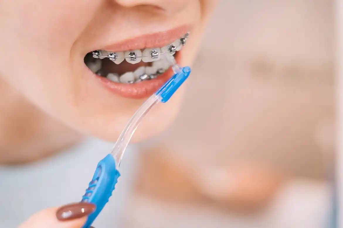 Ortodontik Diş Teli Fırçası Kullanımı ve Ağız Sağlığına Etkileri Hakkında Kapsamlı Rehber