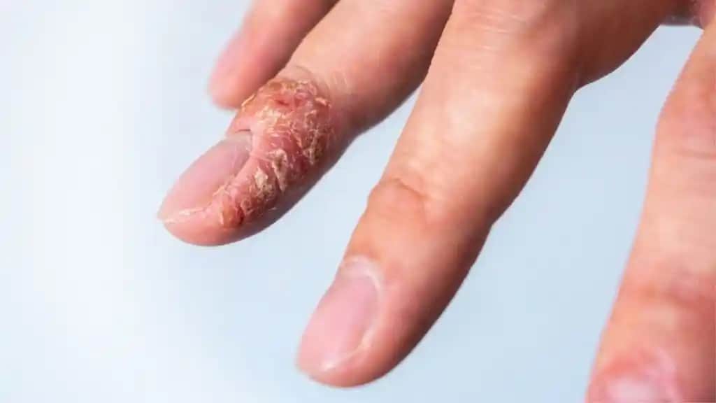 Parmak Ucu Egzaması ve Kozmetik Yaklaşımlar: Doğru Tedavi ve Bakım Yöntemleri