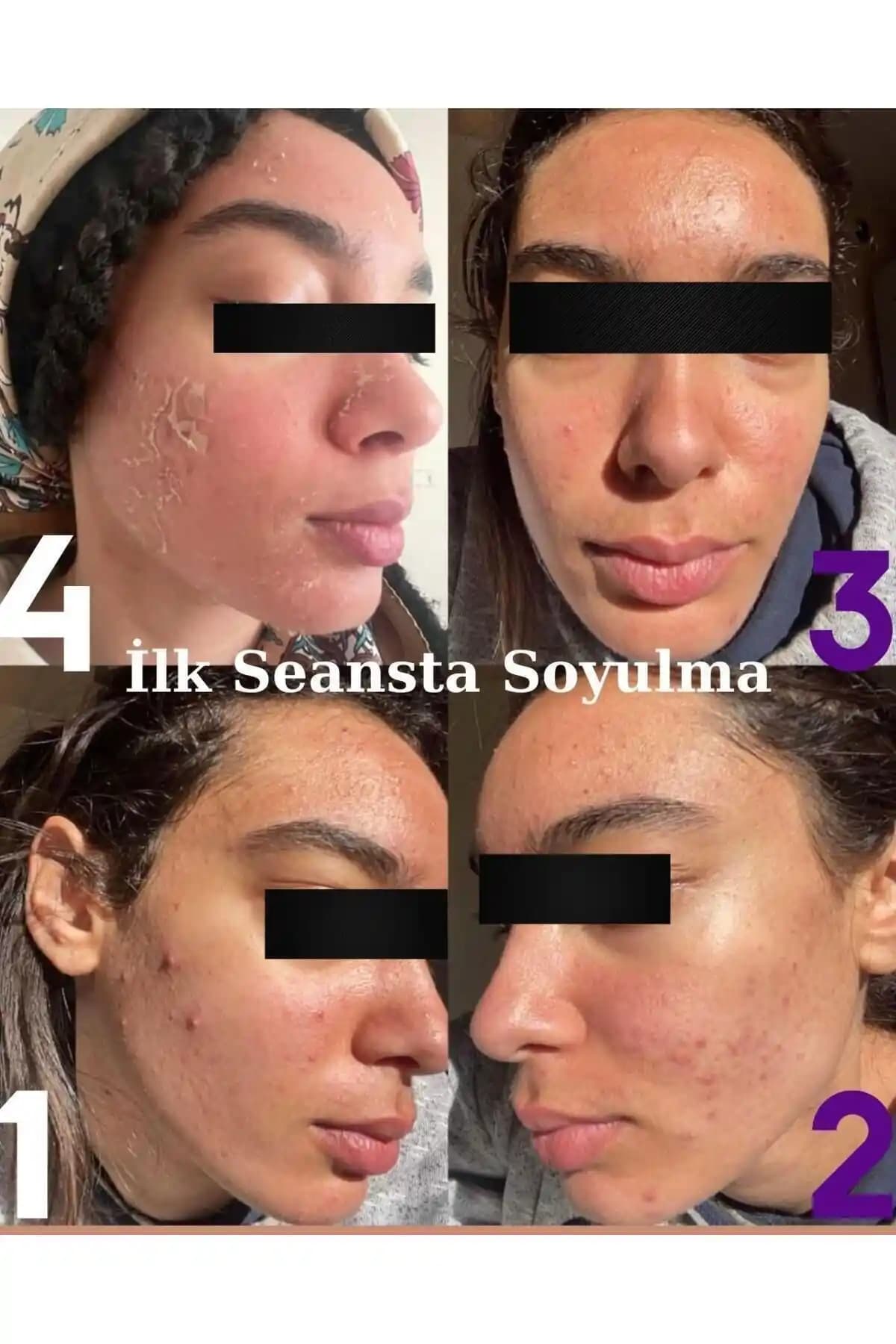 Peeling ile Sağlıklı ve Parlak Cilt İçin Kapsamlı Rehber 2023