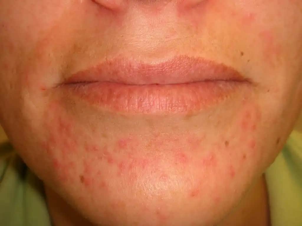 Perioral Dermatitin Çeşitleri Belirtileri ve Güncel Tedavi Yaklaşımları