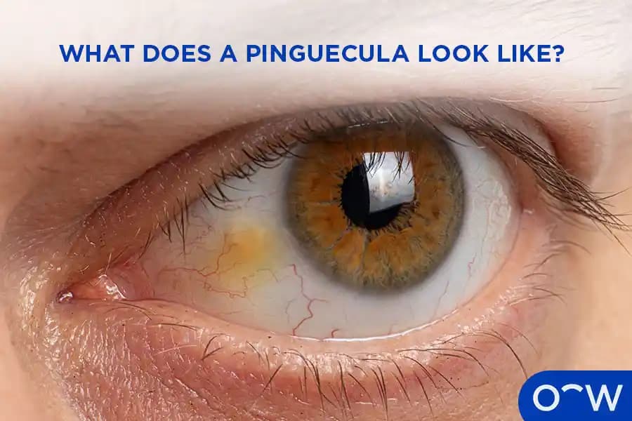 Pinguekula'nın Kozmetik ve Sağlık Açısından Etkileri ve Yönetim Yöntemleri