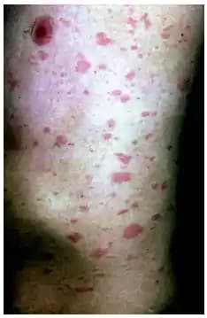 Pityriasis Rosea ve Gül Hastalığı: Belirtileri, Kozmetik Yaklaşımlar ve Bakım Önerileri