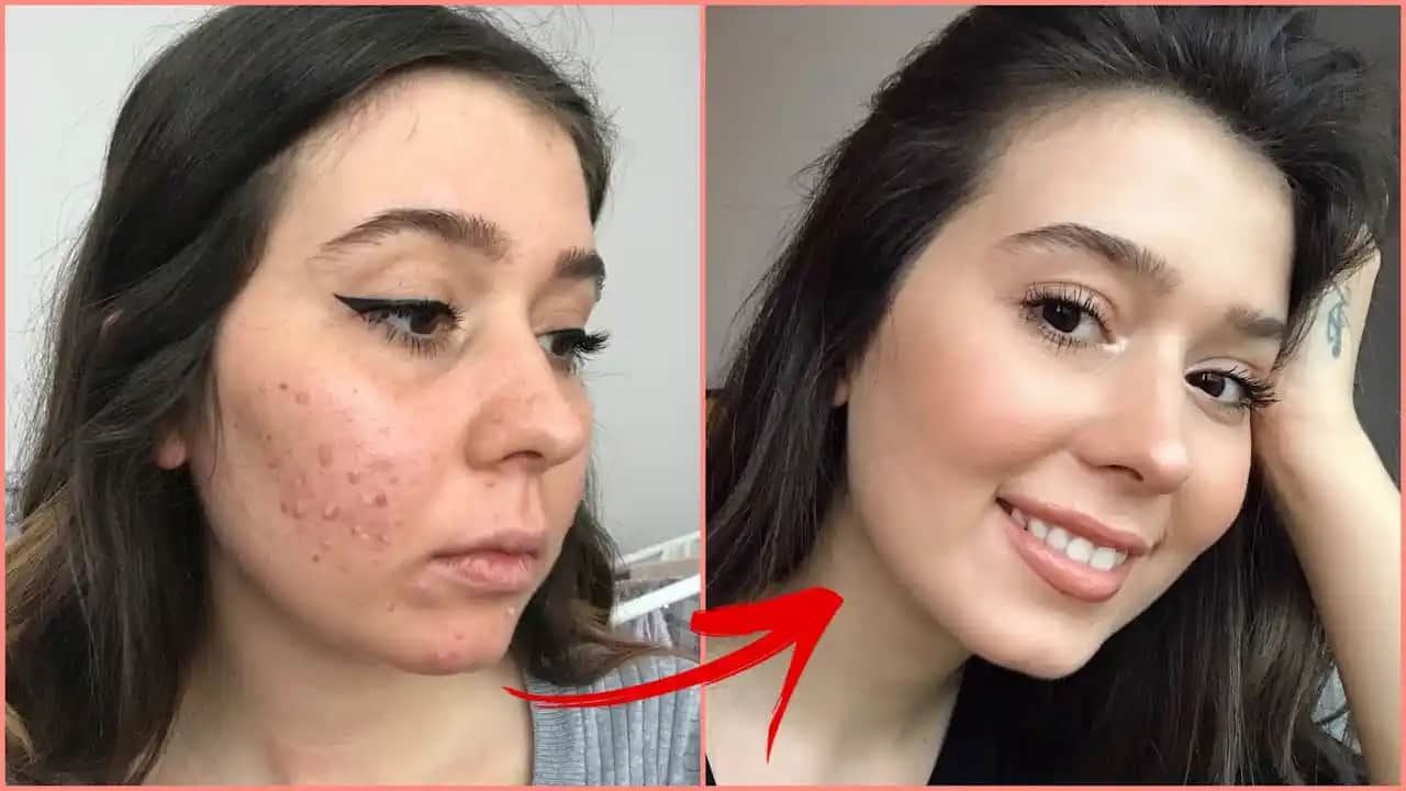 Roaccutane Sonrası Leke Tedavisinde Etkili Krem ve Bakım Yöntemleri