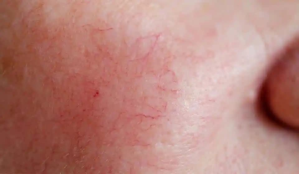 Roza Hastalığı Belirtileri, Nedenleri ve Etkili Cilt Bakım Yöntemleri
