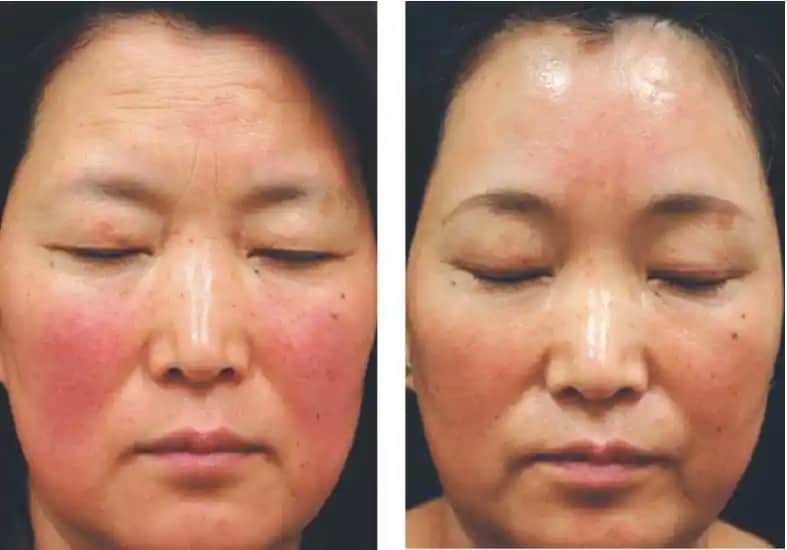 Rozâ Lazer Tedavisi ile Hassas Ciltlerde Damar ve Kızarıklık Sorunlarına Çözüm