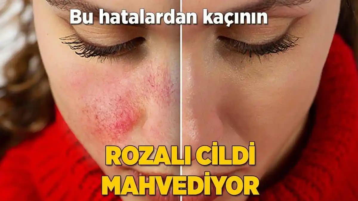 Rozalı Cilt Belirtileri, Nedenleri ve Doğru Bakım Yöntemleri Hakkında Bilgiler