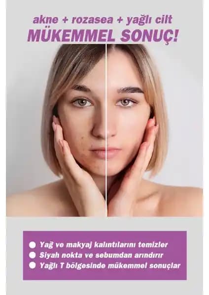 Rozalı Yüz Nedir ve Neden Popüler Olan Doğal Güzellik Uygulamasıdır?