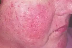 Rozasea Belirtileri ve Cilt Sağlığını Koruma Yöntemleri