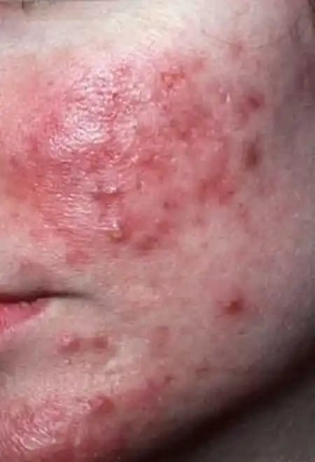 Rozasea Hastalığı ve Kozmetik Yaklaşımlar: Belirtiler, Nedenler ve Tedavi Yöntemleri