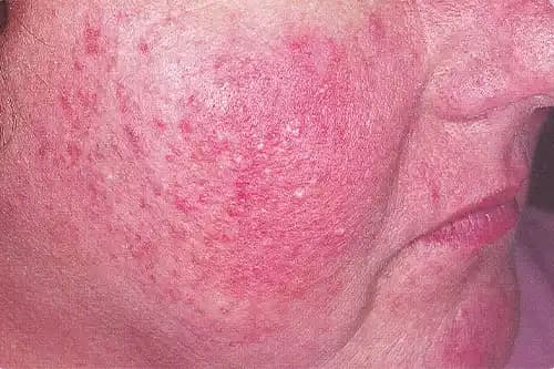 Rozasea ve Cilt Sağlığı İçin Doğru Kozmetik Kullanımı Rehberi