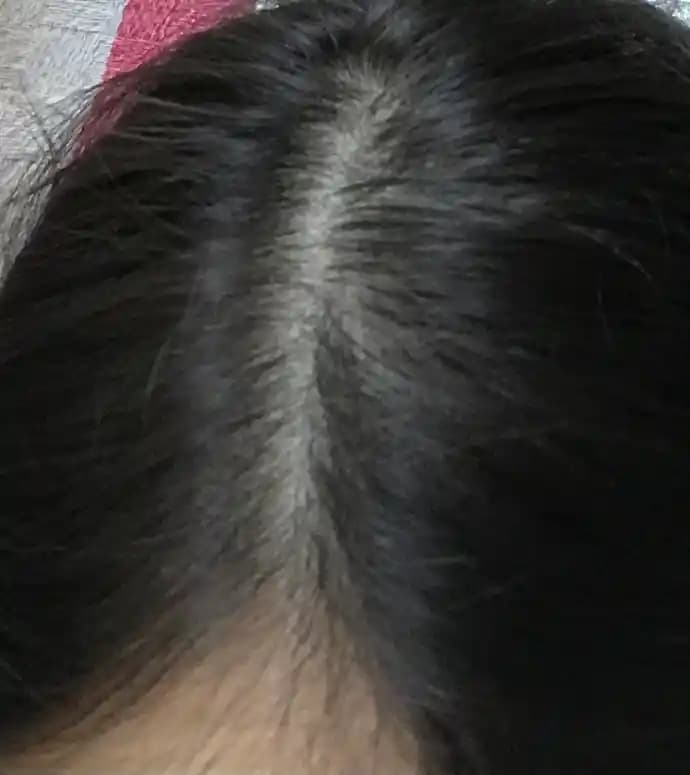 Saç Ağrısı ve Dökülmenin Sağlık Göstergeleri Olarak Önemi ve Uzman Tedavi Yöntemleri