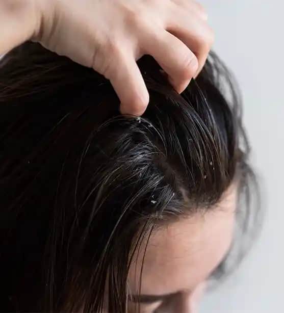 Saç Derisi Hastalıkları ve Kozmetik Yaklaşımlar: Belirtiler, Tedavi ve Doğal Çözümler