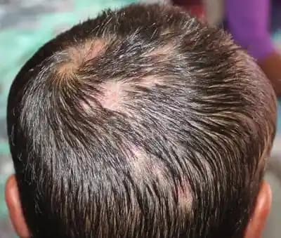 Saç Derisi İltihabı Belirtileri Nedenleri ve Etkili Tedavi Yöntemleri