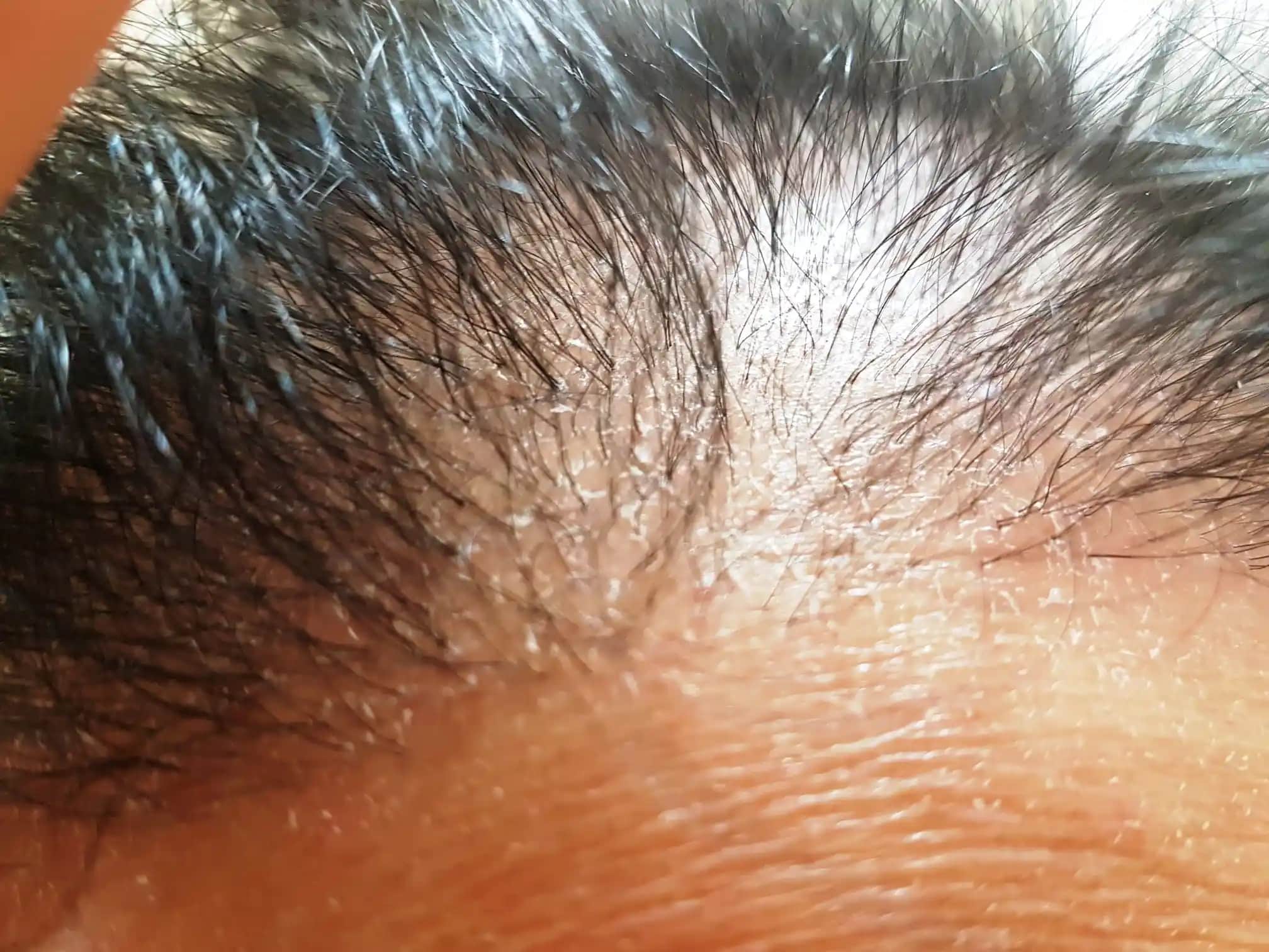 Saç Derisinde Beyaz Tortu Nedenleri, Belirtileri ve Etkili Tedavi Yöntemleri