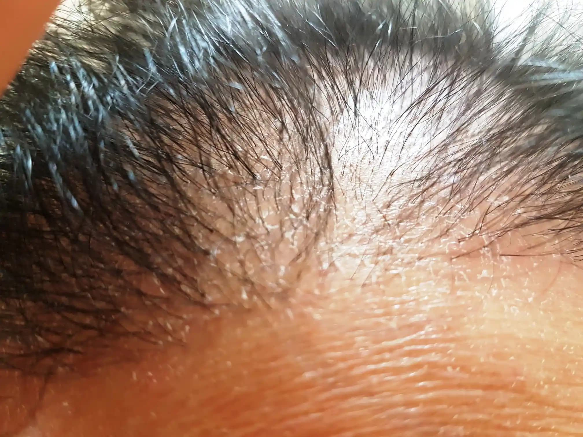 Saç Derisinde Beyaz Tortu Nedenleri, Belirtileri ve Etkili Tedavi Yöntemleri